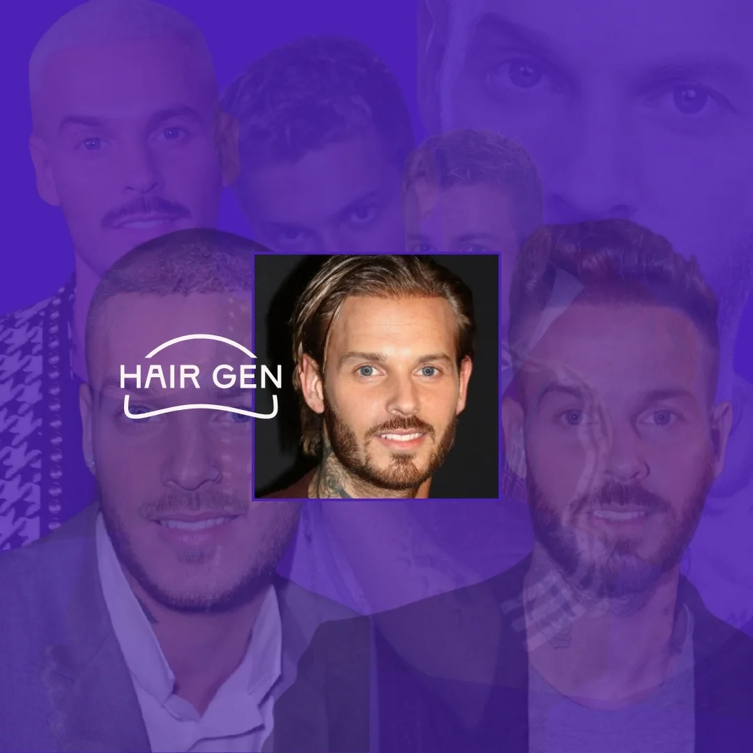 matt-pokora-avant-apr-s-sa-greffe-de-cheveux