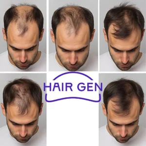Photo avant/après des résultats spectaculaires du finastéride sur les cheveux en un an.
