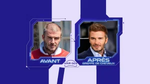 Comparaison côte à côte : à gauche Beckham avec une chevelure clairsemée ("Avant"), à droite avec une densité retrouvée ("Après greffe de cheveux").