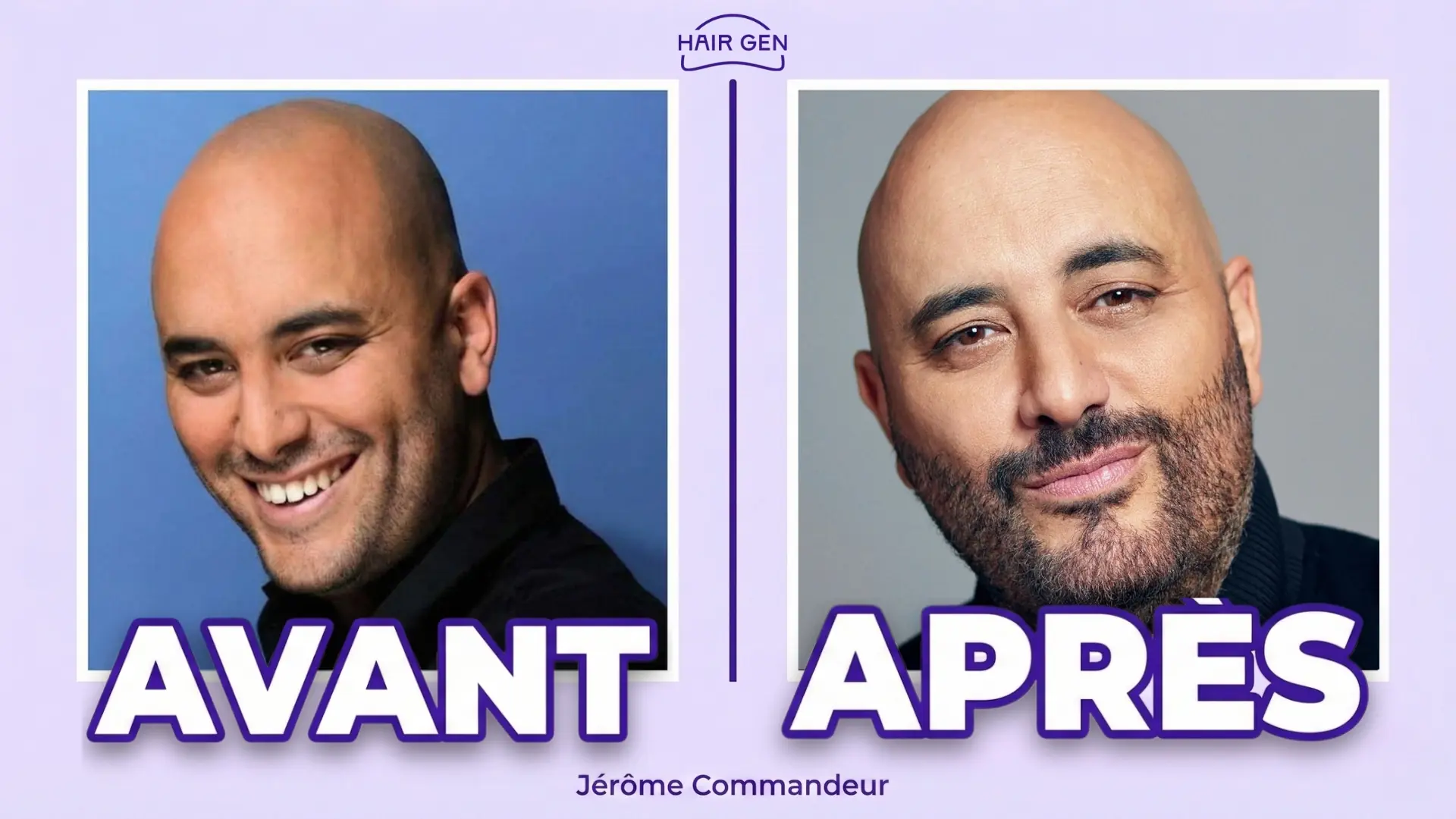 Avant après greffe de cheveux de Jérôme Commandeur ?