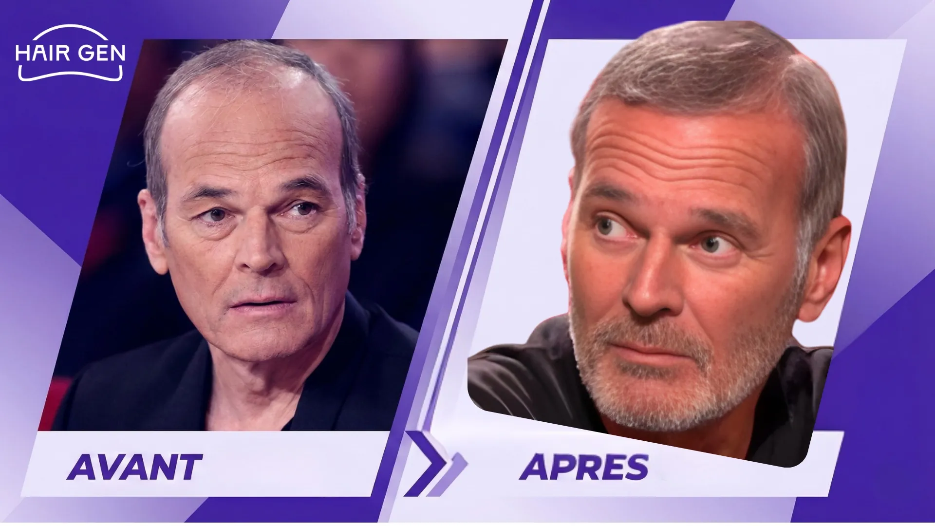 Comparaison en gros plan du visage de Laurent Baffie, montrant son front dégarni à gauche et sa nouvelle ligne frontale dense avec une barbe à droite.
