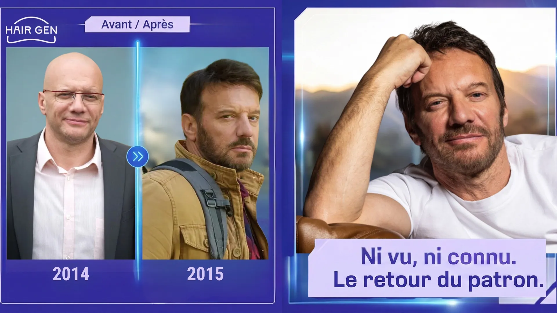 Comparaison avant/après frappante : Samuel Le Bihan chauve en 2014 contre une chevelure restaurée et dense en 2015.
