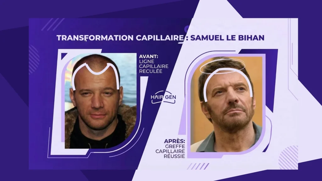 Comparaison visuelle côte à côte de Samuel Le Bihan. À gauche, "Avant" montrant une ligne capillaire reculée ; à droite, "Après" montrant le résultat d'une greffe capillaire réussie avec une ligne frontale redessinée.
