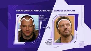 Comparaison visuelle côte à côte de Samuel Le Bihan. À gauche, "Avant" montrant une ligne capillaire reculée ; à droite, "Après" montrant le résultat d'une greffe capillaire réussie avec une ligne frontale redessinée.