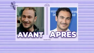 Comparaison côte à côte du visage de Valentin Kretz avant et après sa greffe de cheveux réussie.