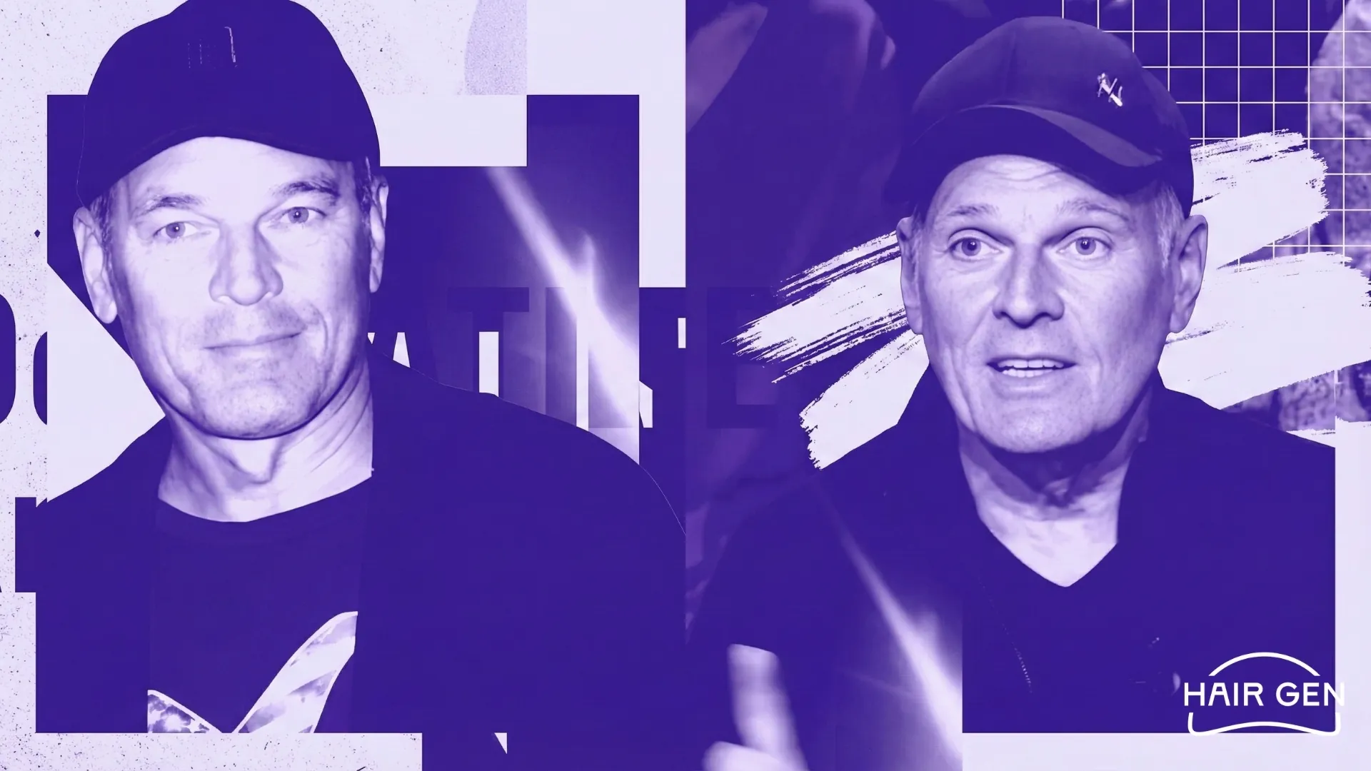 Laurent Baffie portant une casquette noire lors d'émissions, cachant sa perte de cheveux avant l'opération.