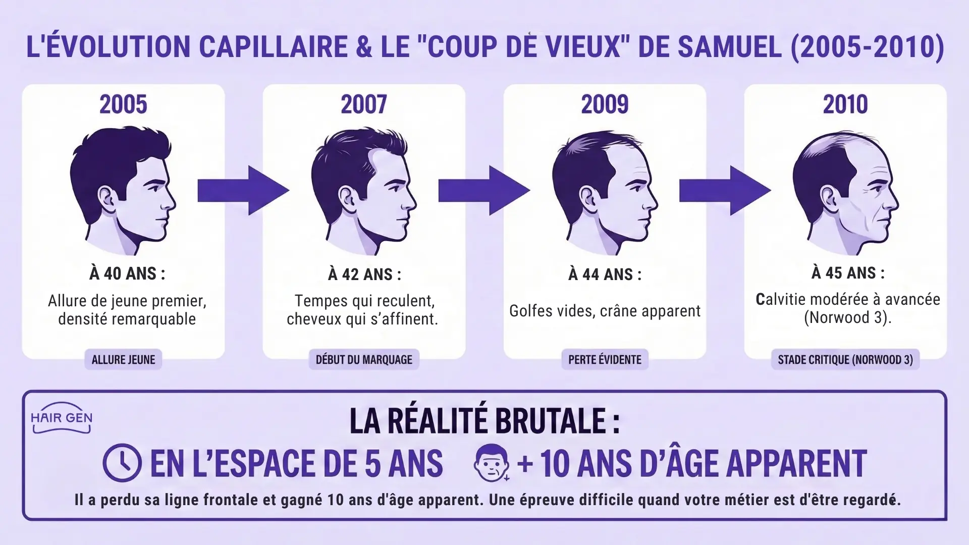 Infographie montrant la progression de la perte de cheveux de Samuel Le Bihan de 40 à 45 ans, passant d'une densité complète à un stade Norwood 3.