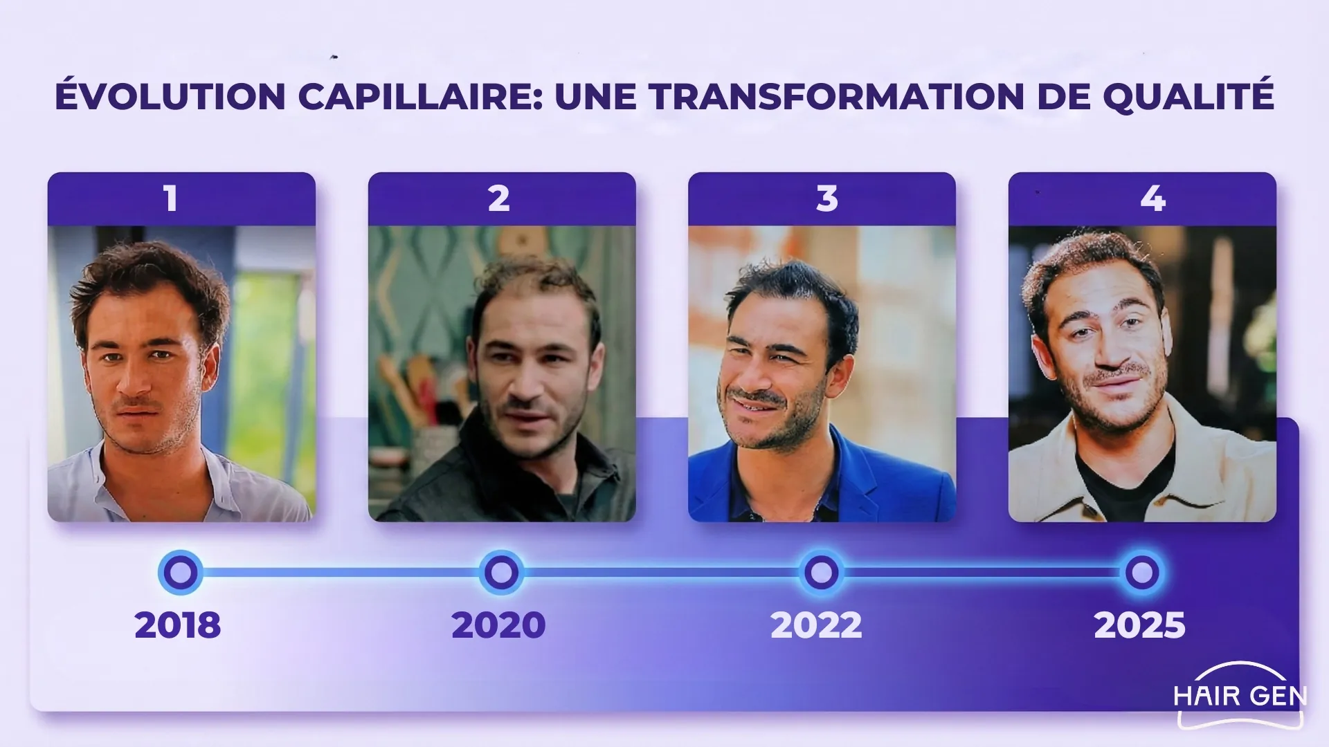 Frise chronologique détaillant l'évolution capillaire de Valentin Kretz avec des photos datées de 2018, 2020, 2022 et 2025.