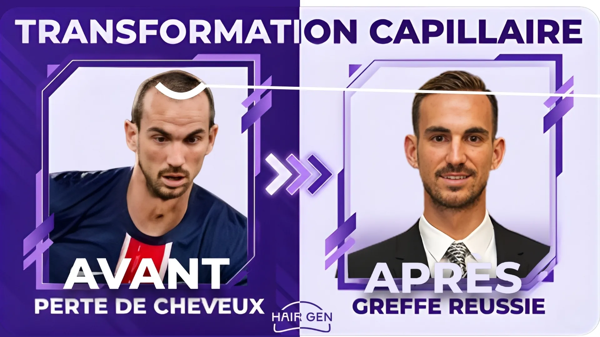 Panneau comparatif Transformation Capillaire montrant Ruiz Avant (perte de cheveux) et Après (greffe réussie en costume cravate).