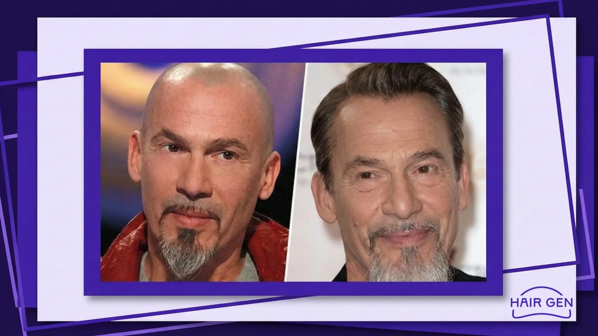 Florent Pagny assume sa greffe