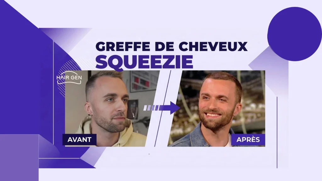 Photo avant après la greffe capillaire de Squeezie.