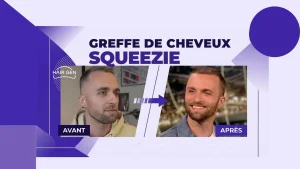 Photo avant après la greffe capillaire de Squeezie.