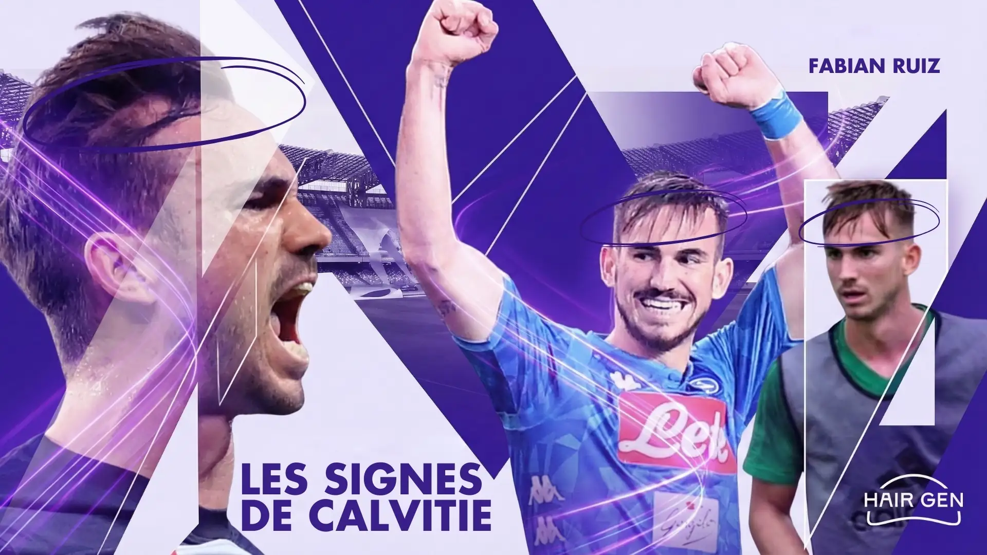Montage photo de Fabián Ruiz sur le terrain, avec des cercles violets mettant en évidence l'éclaircissement de ses cheveux et le recul de sa ligne frontale.