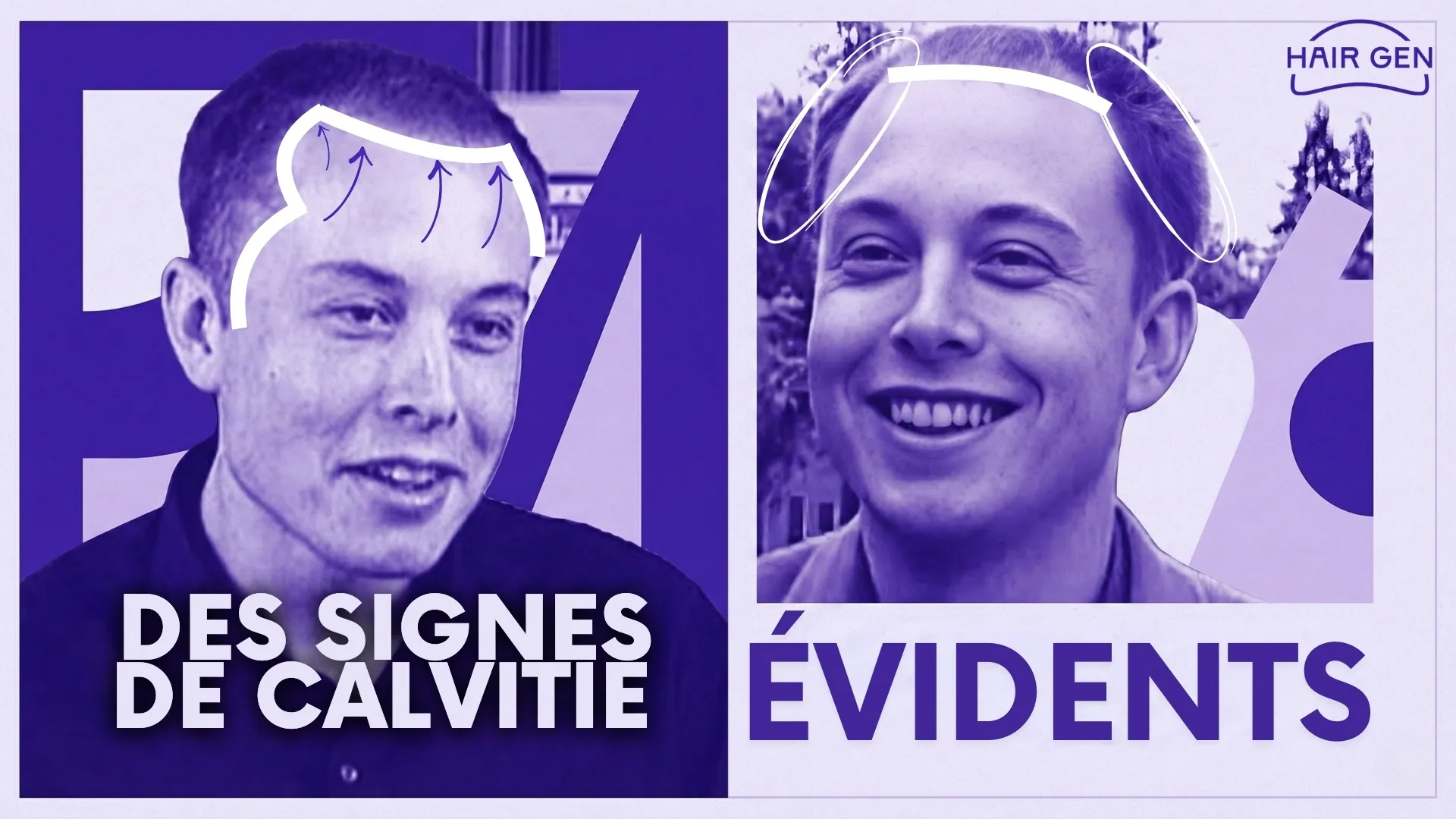 Deux photos d'Elon Musk jeune avec des annotations graphiques mettant en évidence le recul important de la ligne frontale et le dégarnissement des golfes temporaux.