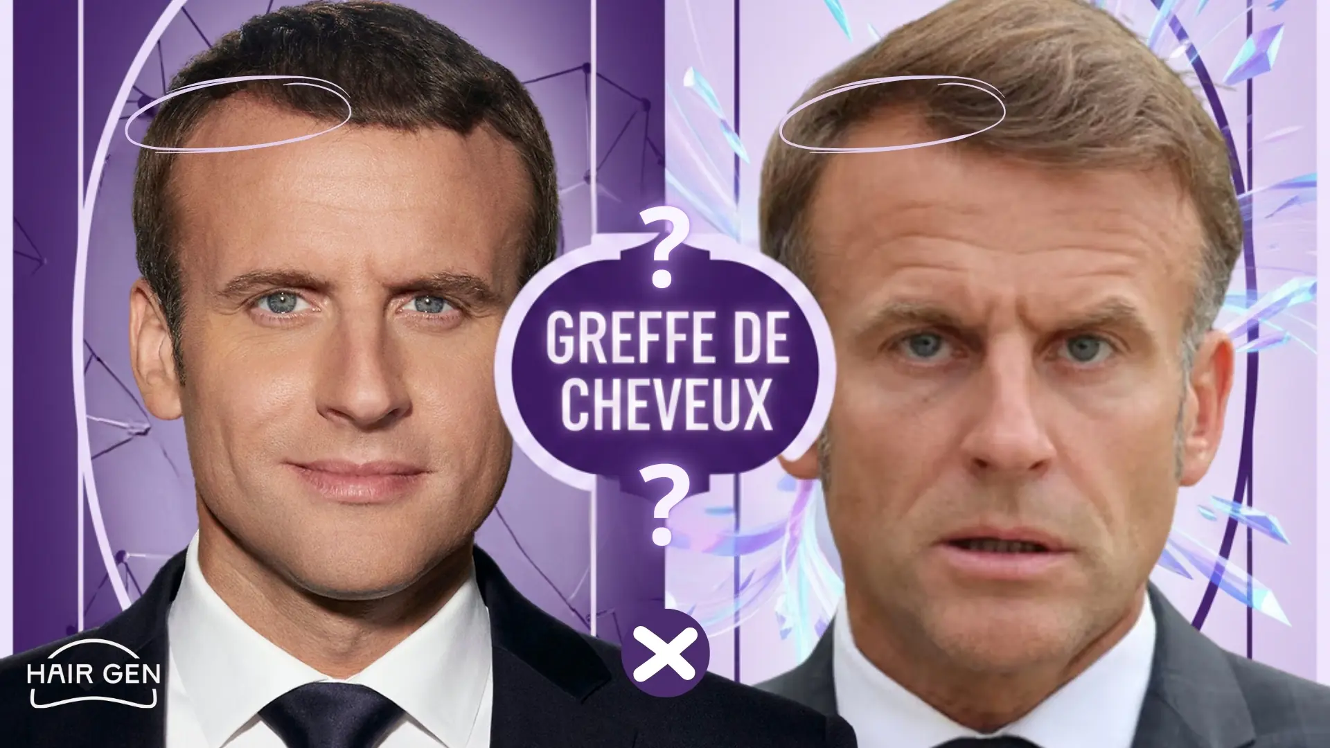 Deux photos d'Emmanuel Macron côte à côte avec des cercles sur la ligne frontale et la mention centrale Greffe de cheveux ?