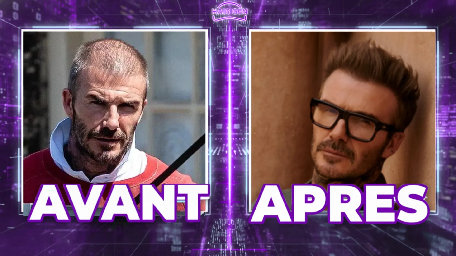 Comparaison avant-après montrant à gauche David Beckham avec une calvitie visible et à droite avec une chevelure densifiée et des lunettes noires.