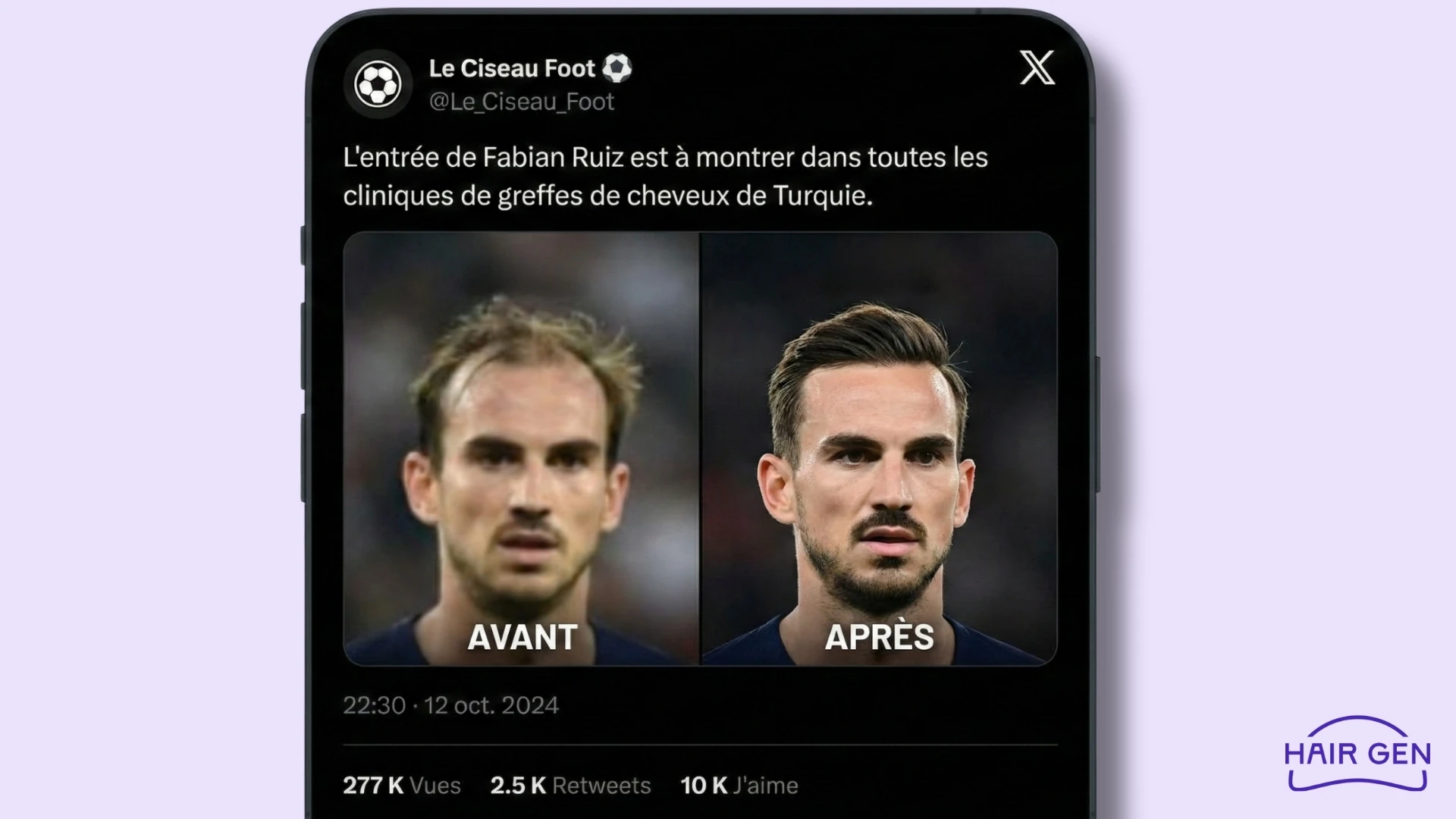 Capture d'écran d'un tweet populaire montrant un avant/après saisissant du visage de Fabián Ruiz, plaisantant sur l'efficacité des greffes en Turquie.