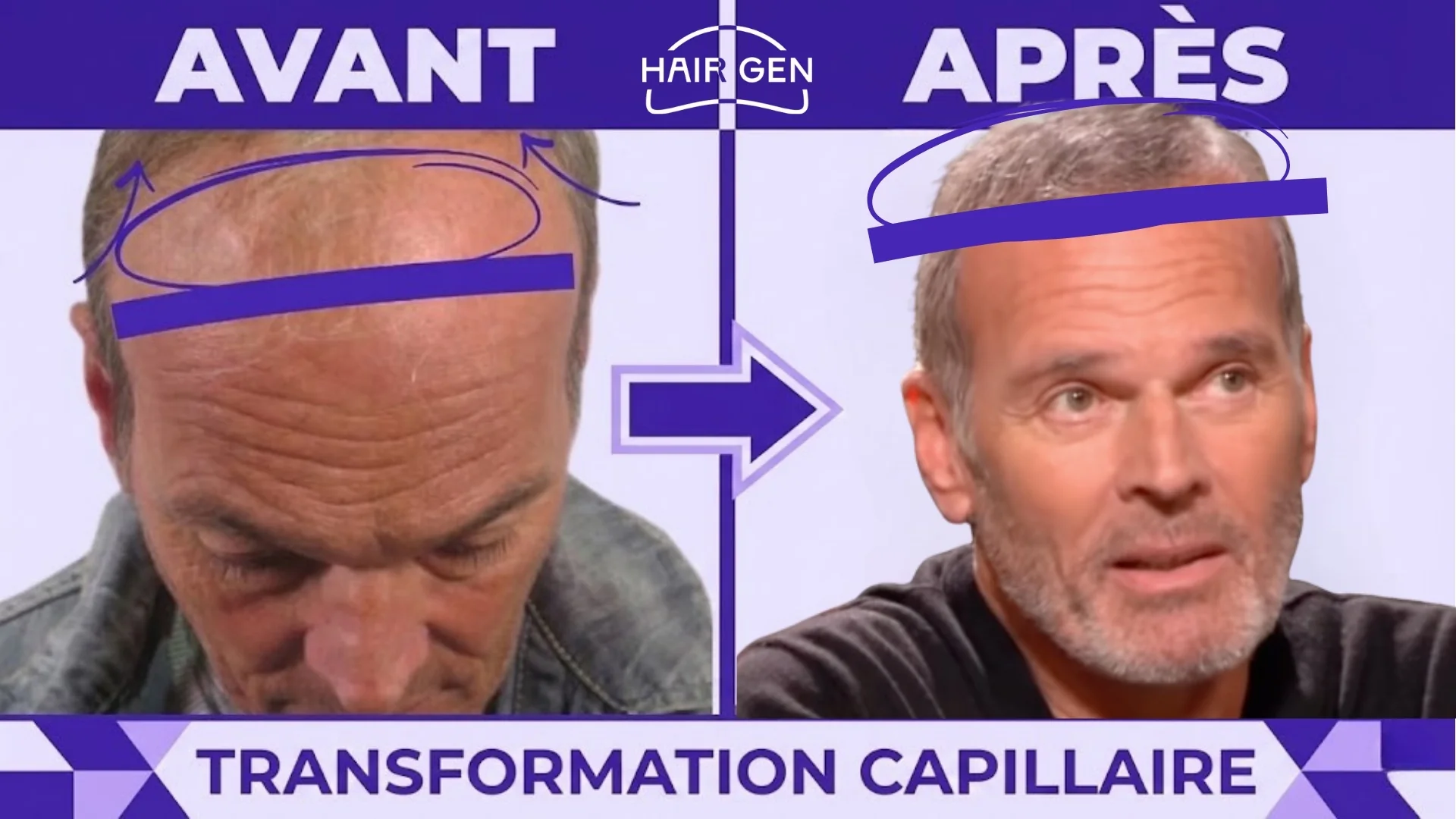 Gros plan comparatif du sommet du crâne avant et après l'opération, mettant en évidence la zone de redensification.