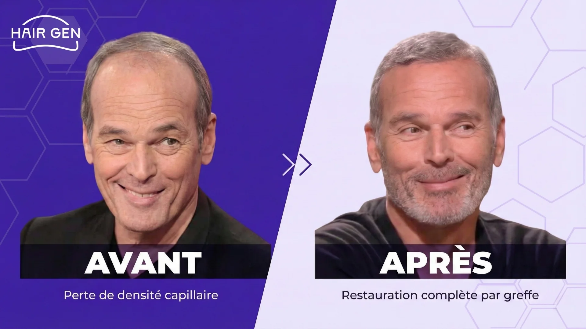 Comparaison photo scindée montrant le visage de Laurent Baffie dégarni à gauche et avec une chevelure fournie à droite.