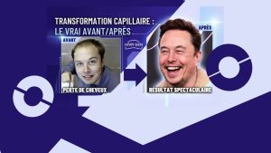 Comparaison directe en écran scindé : à gauche Elon Musk dégarni ("Perte de cheveux") et à droite souriant avec des cheveux denses après sa greffe de cheveux.("Résultat spectaculaire").
