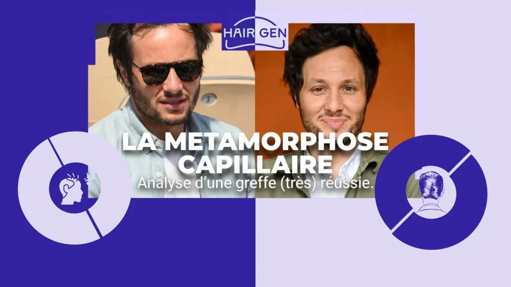 Avant/après la greffe de cheveux de Vianney.