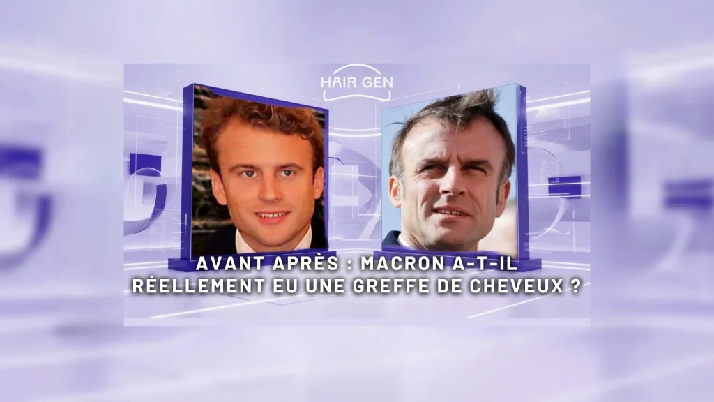 Comparaison en écran scindé entre une photo de Macron jeune et une photo récente, posant la question d'une greffe capillaire.