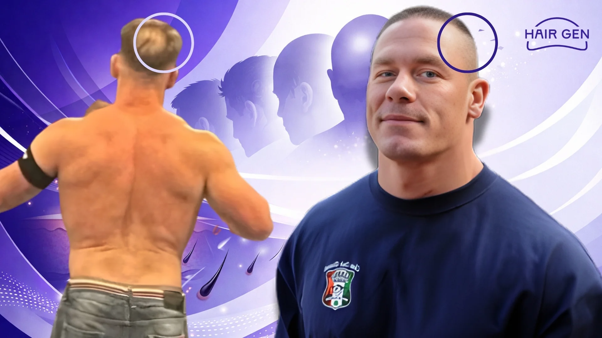 Analyse visuelle de la calvitie de John Cena au niveau du vertex et des tempes avant intervention capillaire.