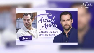 Avant Après Greffe capillaire d'Henry Cavill