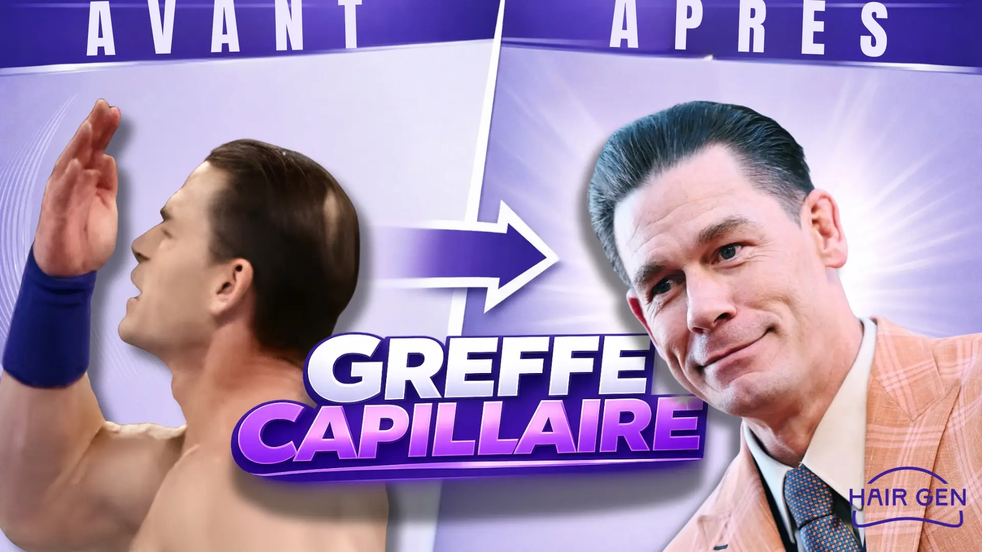 Transformation capillaire de John Cena : comparatif avant-après montrant la correction d'une calvitie au vertex par greffe de cheveux.