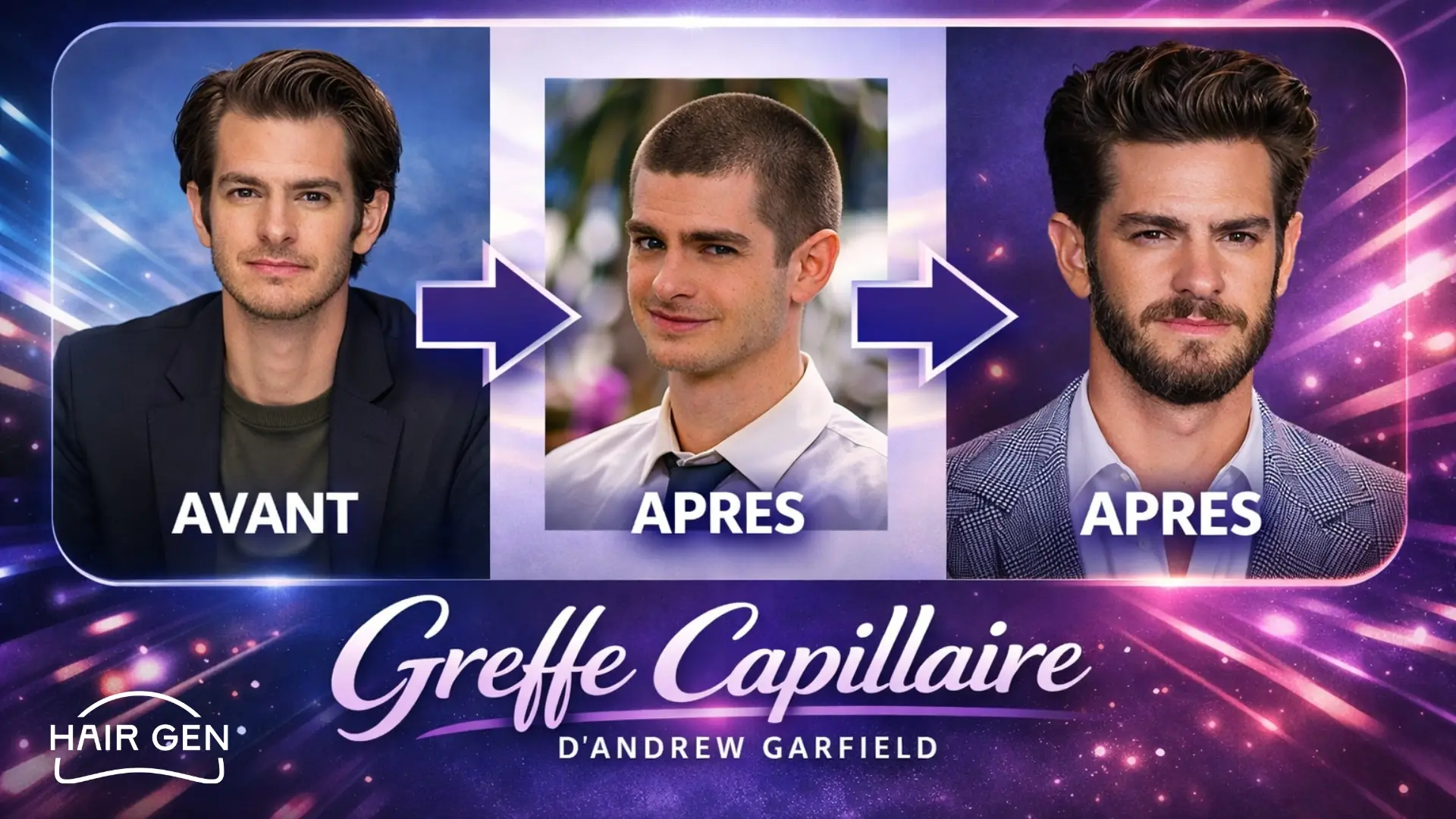 Avant Après la Greffe de Cheveux d'Andrew Garfield.