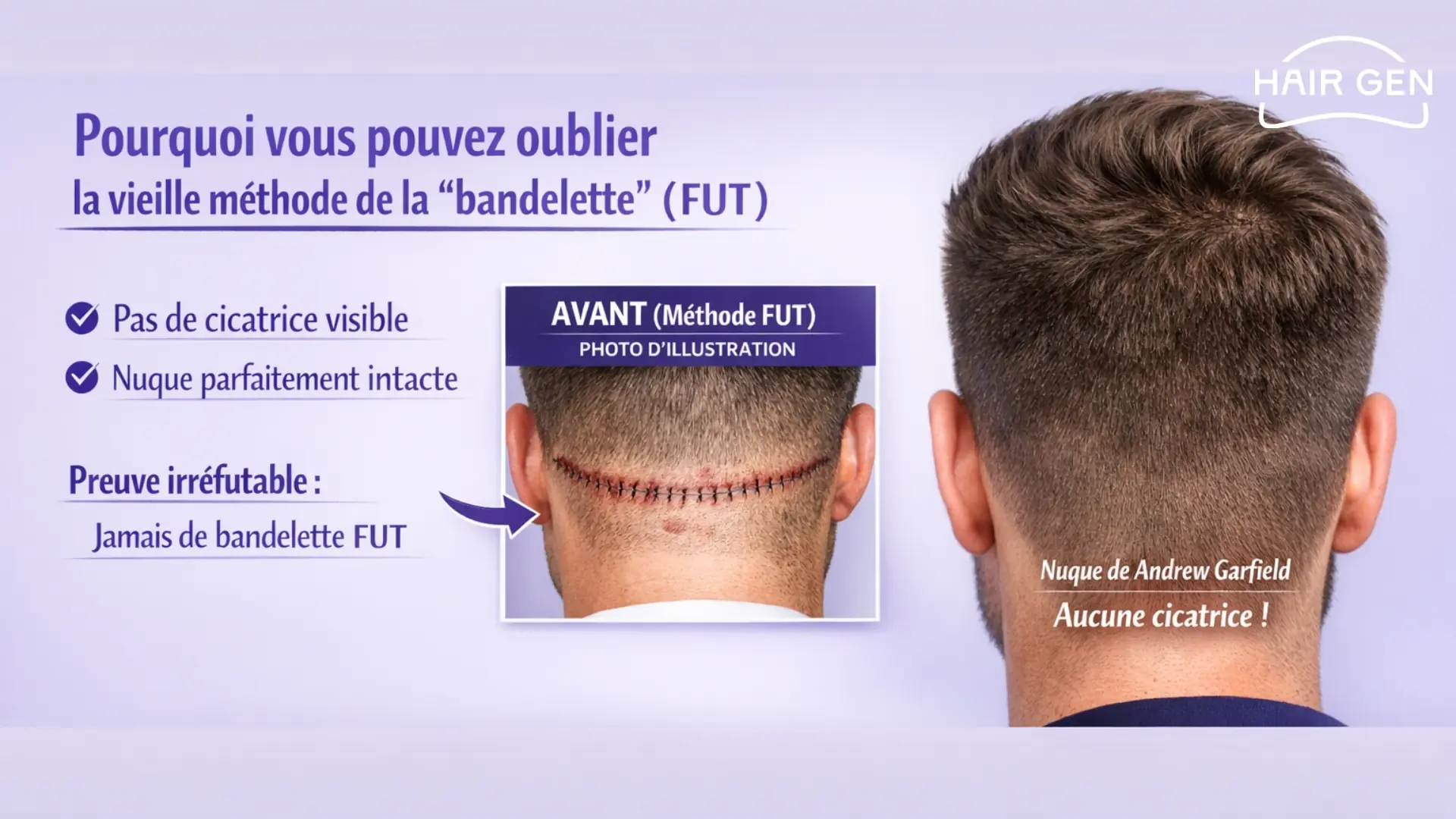 Comparaison entre la cicatrice d'une greffe FUT et la nuque sans cicatrice.