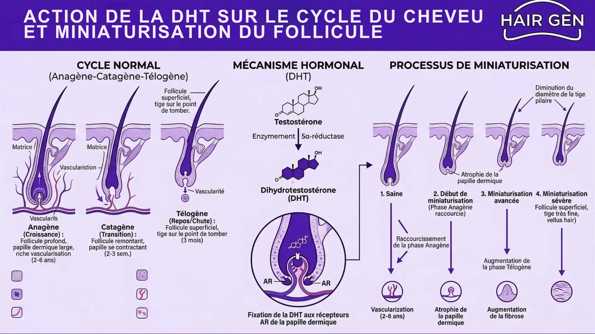 Schéma médical ultra-détaillé illustrant l'action de la DHT sur le cycle de vie du cheveu et la miniaturisation du follicule pileux.