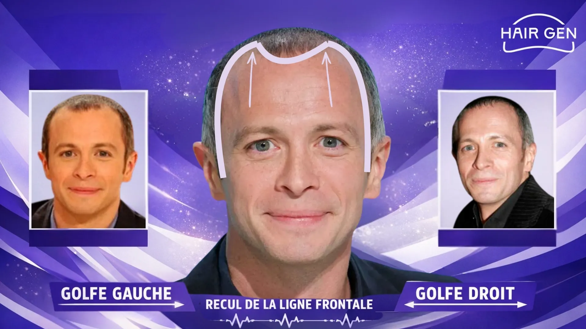 Analyse de la ligne frontale et des golfes de Samuel Etienne.