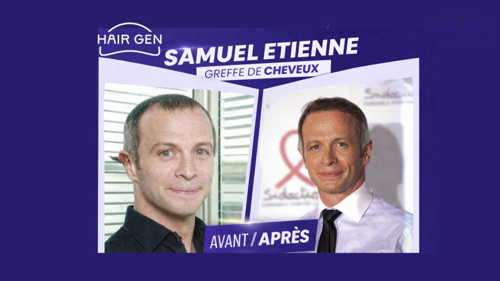 Comparaison avant après greffe de cheveux Samuel Etienne