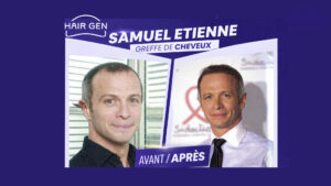 Comparaison avant après greffe de cheveux Samuel Etienne