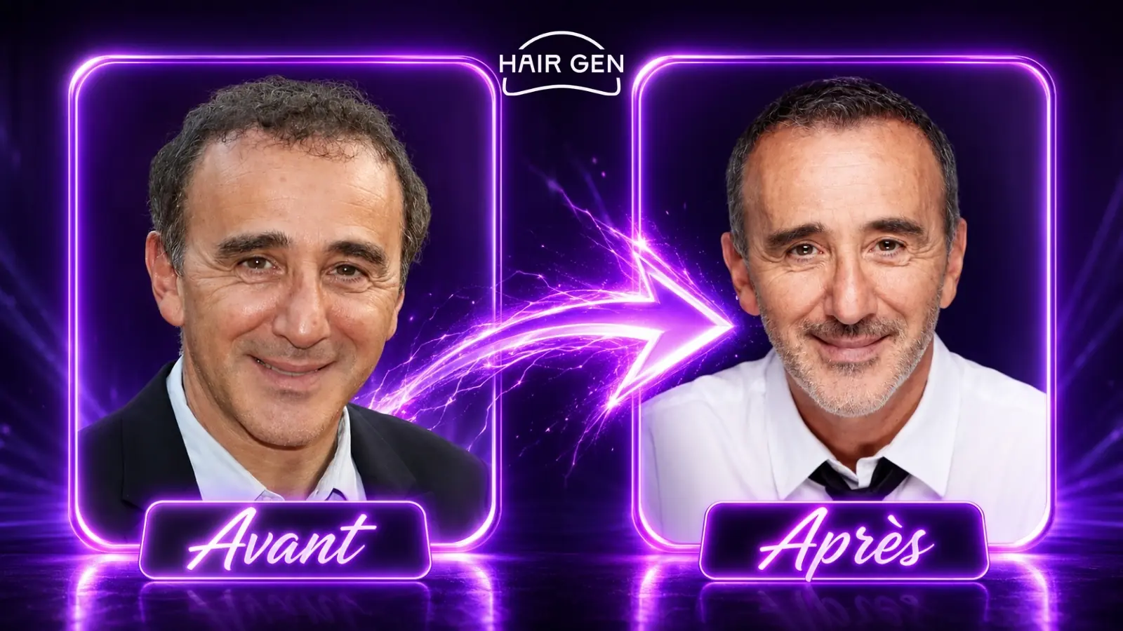 Élie Semoun greffe de cheveux avant après évolution capillaire