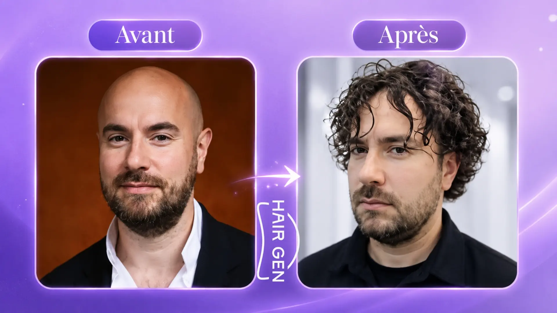 Kyan Khojandi avant après cheveux calvitie prothèse capillaire conclusion