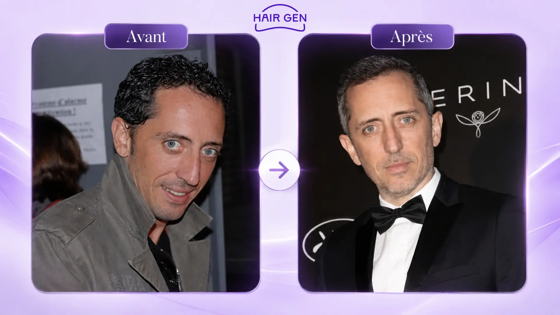 Avant après la greffe de cheveux de Gad Elmaleh.