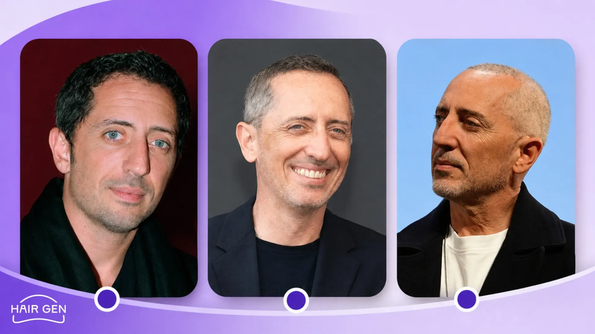 Gad Elmaleh avant après greffe de cheveux implants capillaires et cheveux blancs