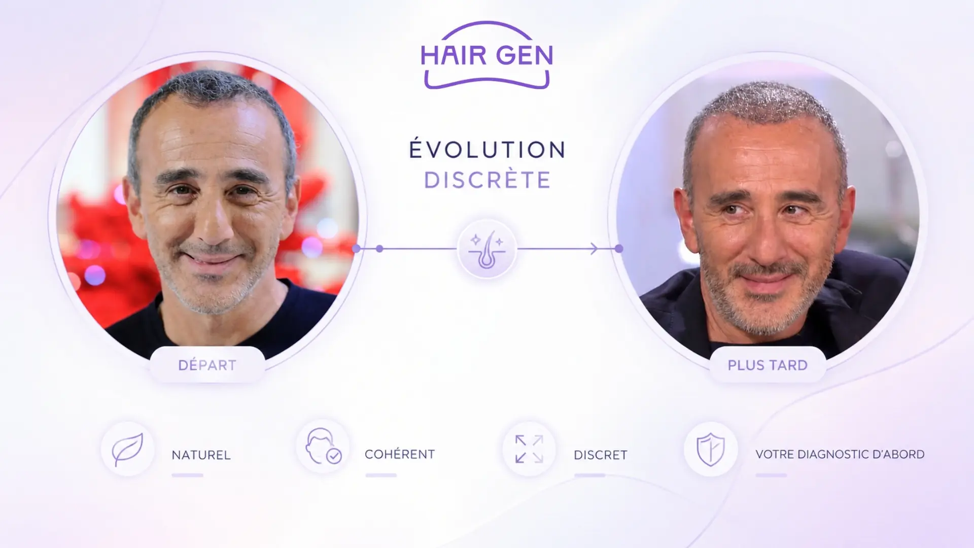 Élie Semoun conclusion avant après greffe cheveux évolution capillaire naturelle