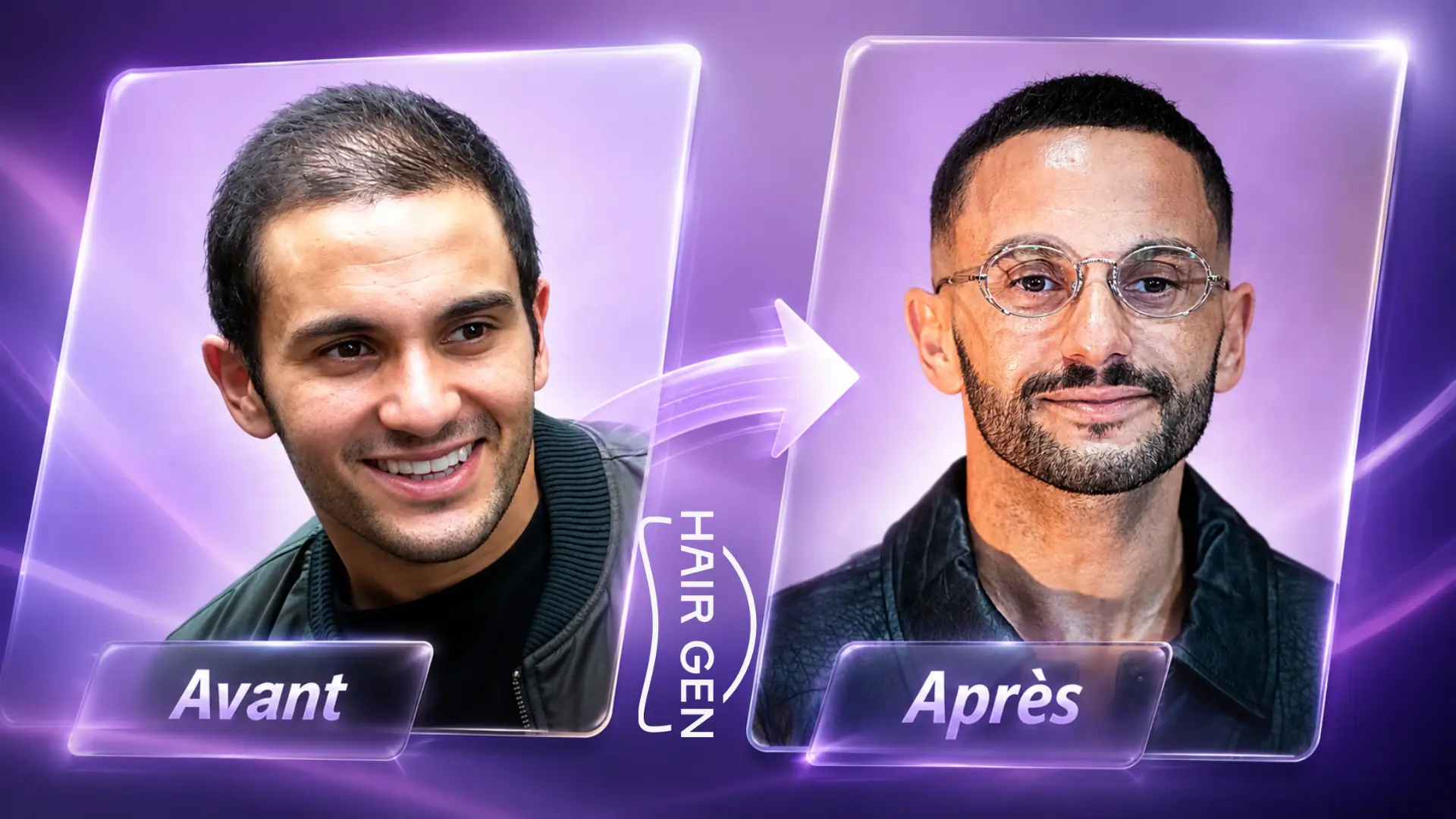 Malik Bentalha greffe de cheveux avant après implants rumeurs évolution capillaire