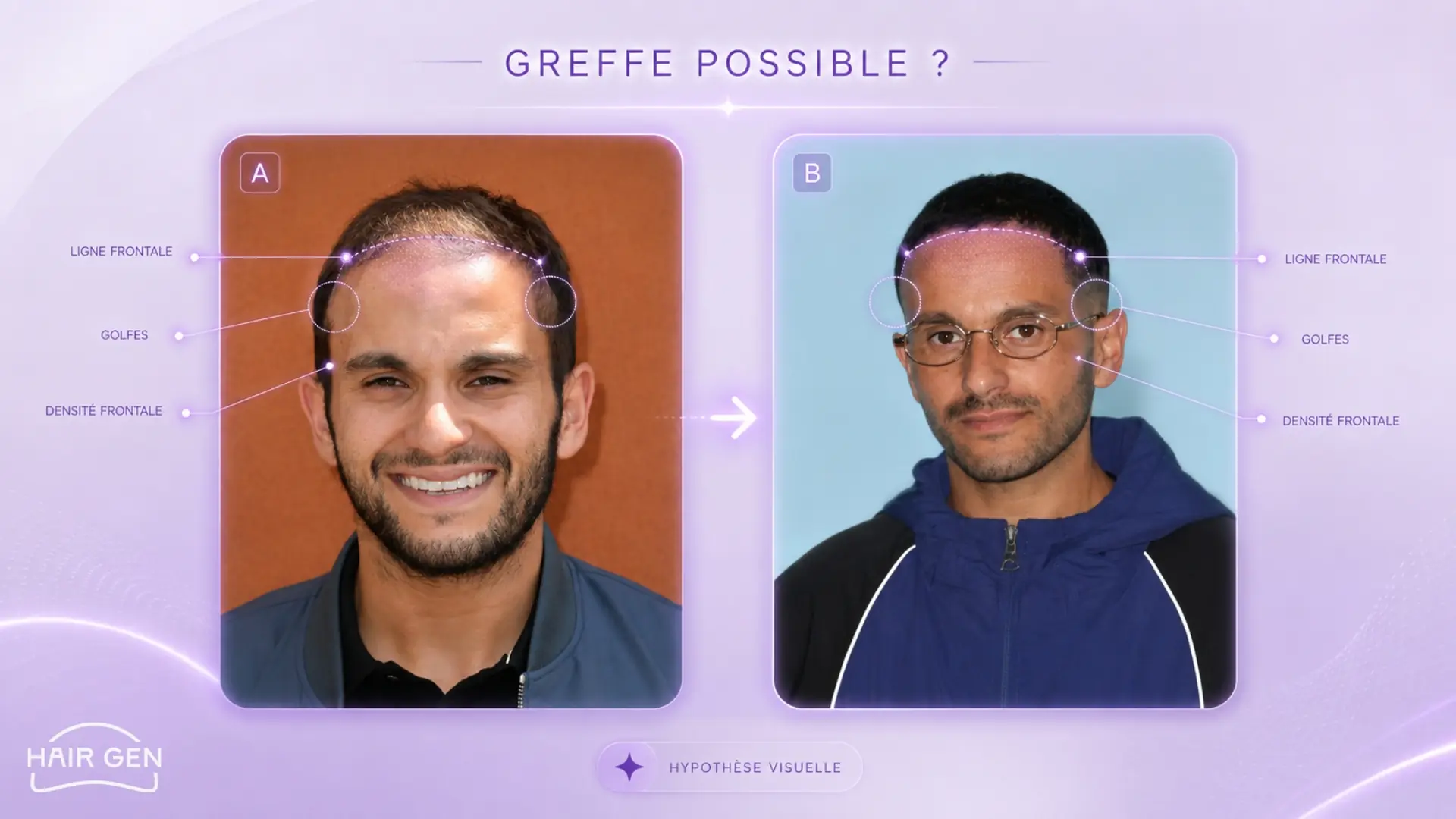 Malik Bentalha ligne frontale densité capillaire barbe silhouette transformée