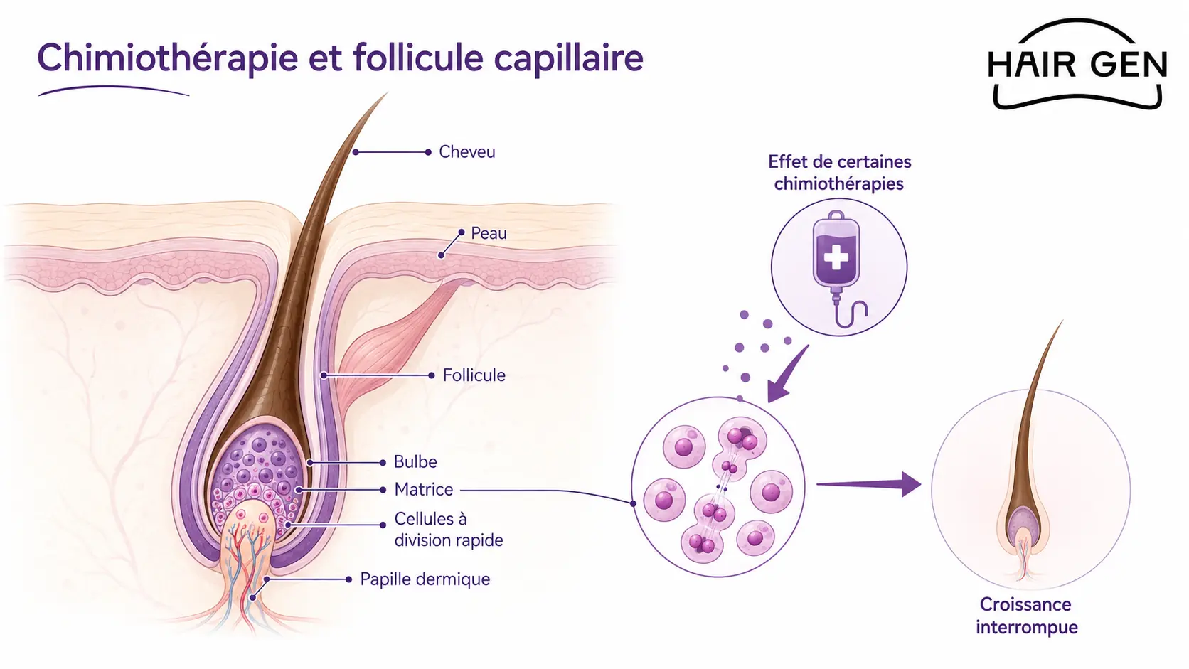 Illustration du follicule capillaire et du m&eacute;canisme de chute des cheveux sous chimioth&eacute;rapie